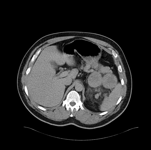 No contrast in Aorta