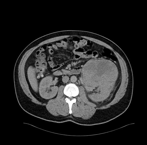 No contrast in kidney